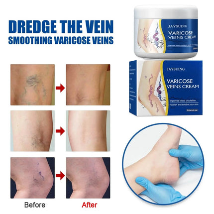 Pain Relief Leg Spider Veins Vasculitis Promote Circulation Smooth Metabolism 30g Exfoliation